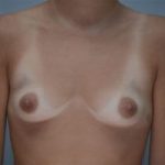 Breast Augmentation Before & After Patient #301