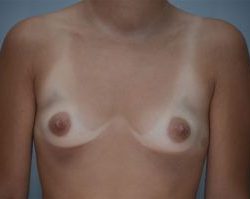 Breast Augmentation Before & After Patient #301