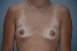 Breast Augmentation Before & After Patient #301