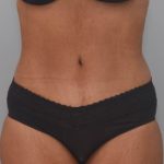 Abdominoplasty Before & After Patient #1386