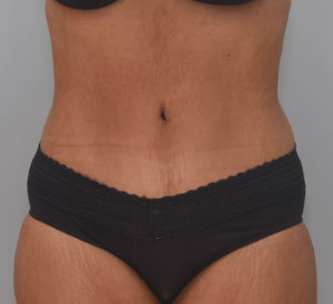 Abdominoplasty Before & After Patient #1386
