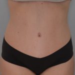 Abdominoplasty Before & After Patient #1385