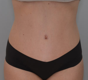 Abdominoplasty Before & After Patient #1385