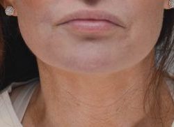 Neck Liposuction Before & After Patient #2003