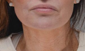 Neck Liposuction Before & After Patient #2003