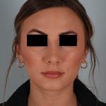 Rhinoplasty Before & After Patient #2113