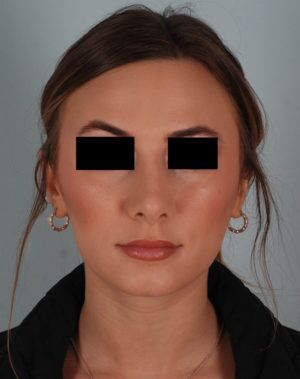 Rhinoplasty Before & After Patient #2113