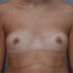 Breast Augmentation Before & After Patient #358