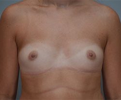 Breast Augmentation Before & After Patient #358