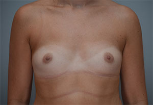 Breast Augmentation Before & After Patient #358
