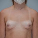 Breast Augmentation Before & After Patient #360