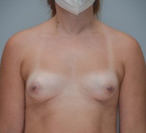 Breast Augmentation Before & After Patient #360