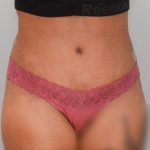 Liposuction Before & After Patient #1641
