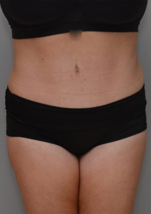 Abdominoplasty Before & After Patient #1211