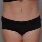 Abdominoplasty Before & After Patient #1590