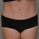 Liposuction Before & After Patient #1590