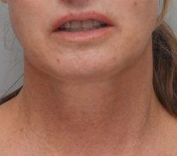 Facetite Before & After Patient #1780