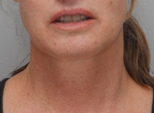 Facetite Before & After Patient #1780