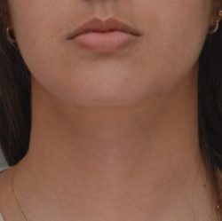 Neck Liposuction Before & After Patient #1948