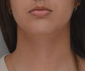 Neck Liposuction Before & After Patient #1948