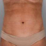 Liposuction with Bodytite Before & After Patient #1557