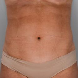 Liposuction with Bodytite Before & After Patient #1557