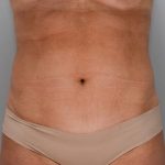 Liposuction Before & After Patient #1646