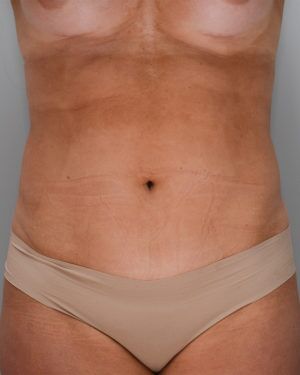 Liposuction Before & After Patient #1646