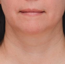 Facetite Before & After Patient #1776