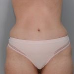 Abdominoplasty Before & After Patient #1270