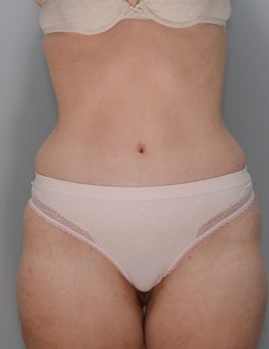 Abdominoplasty Before & After Patient #1270