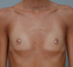 Breast Augmentation Before & After Patient #411