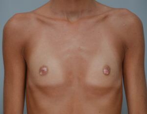 Breast Augmentation Before & After Patient #411