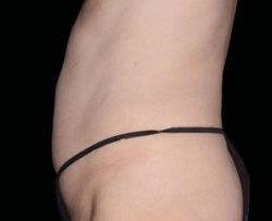 Emsculpt Neo Before & After Patient #2157