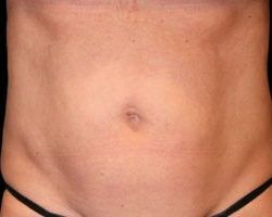 Emsculpt Neo Before & After Patient #2161