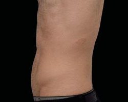 Emsculpt Neo Before & After Patient #2160