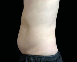 Emsculpt Neo Before & After Patient #2159