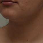 Neck Liposuction Before & After Patient #2004