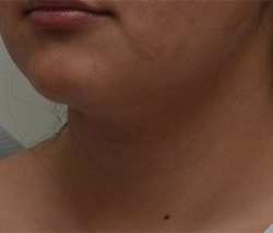 Neck Liposuction Before & After Patient #2004