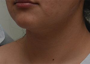 Neck Liposuction Before & After Patient #2004