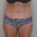 Abdominoplasty Before & After Patient #1209