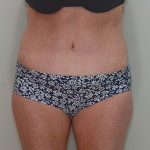 Liposuction Before & After Patient #1588