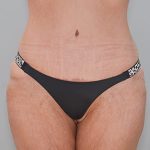 Abdominoplasty Before & After Patient #1327