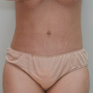 Abdominoplasty Before & After Patient #1208