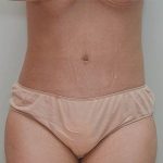 Abdominoplasty Before & After Patient #1587