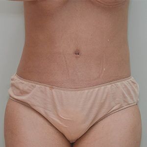 Liposuction Before & After Patient #1587