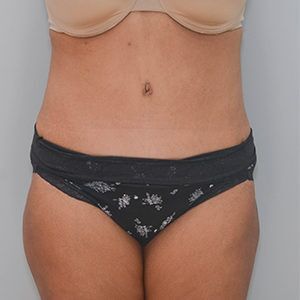 Abdominoplasty Before & After Patient #1207