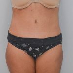 Abdominoplasty Before & After Patient #1586