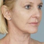 Laser Skin Resurfacing Before & After Patient #2218