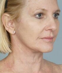 Laser Skin Resurfacing Before & After Patient #2218